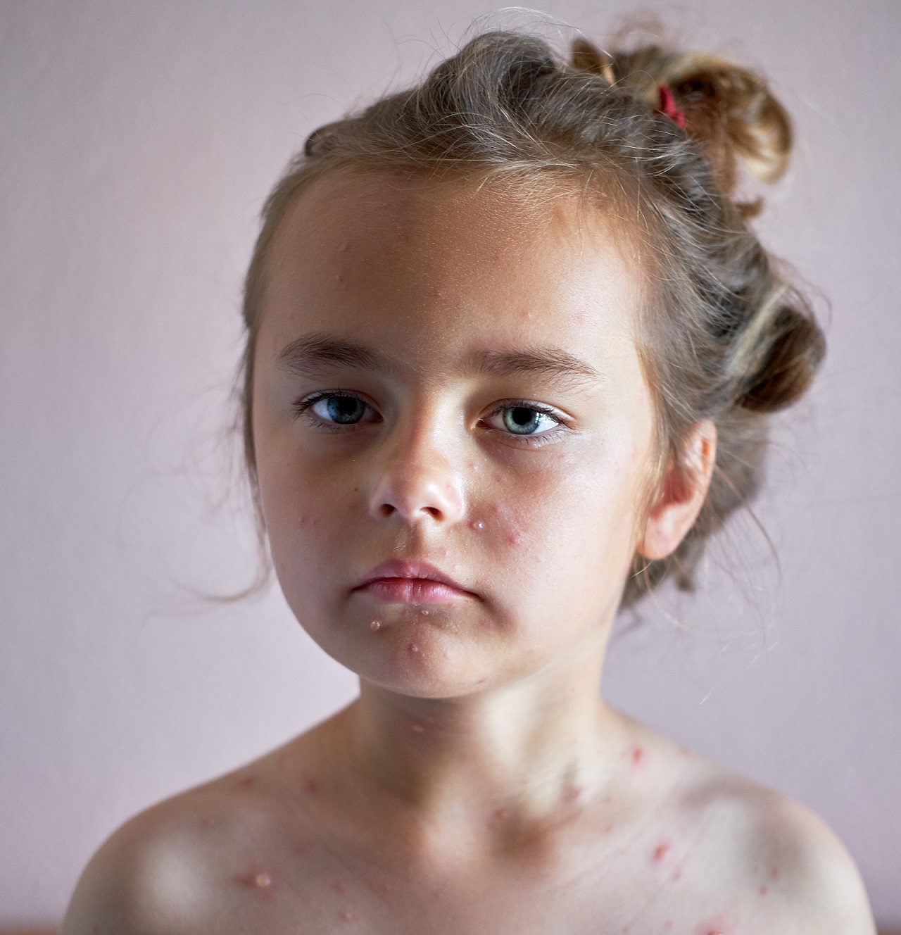 girl with chickenpox