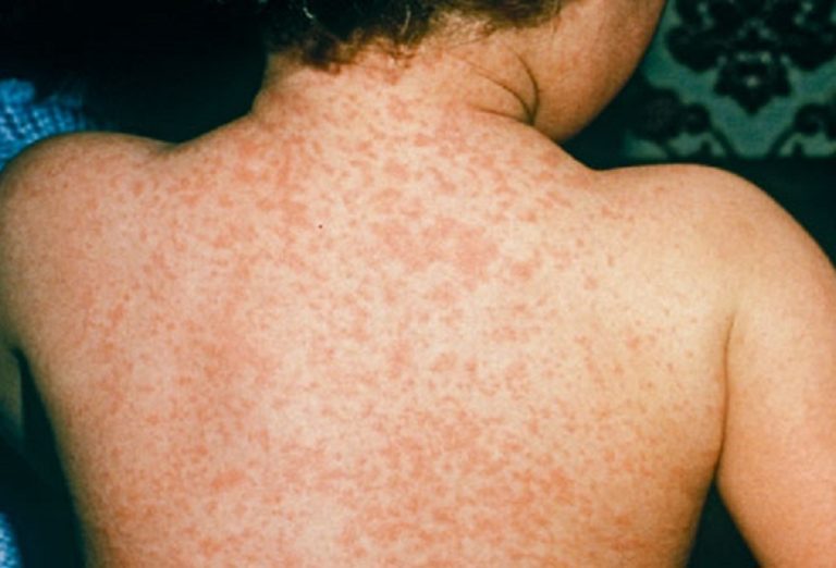 measles rash on back