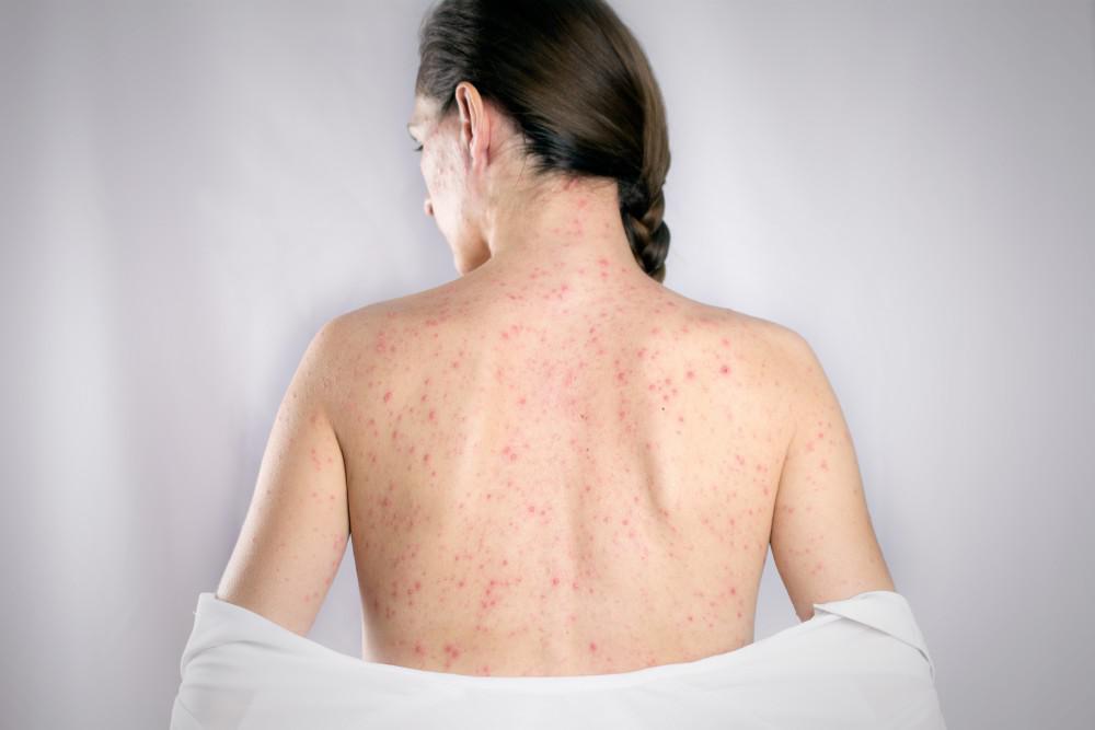 shingles on the back of a woman